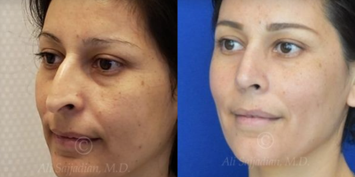Case 4332 - Woman treated with Rhinoplasty