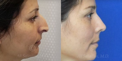 Case 4333 - Woman treated with Rhinoplasty