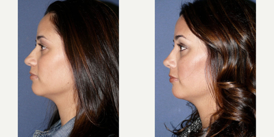 Case 4334 - Woman treated with Rhinoplasty