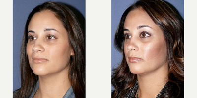 Case 4335 - Woman treated with Rhinoplasty
