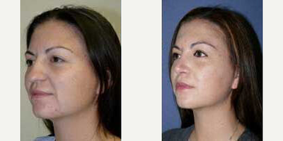 Case 4336 - Woman treated with Rhinoplasty