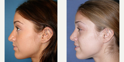 Case 4337 - Woman treated with Rhinoplasty