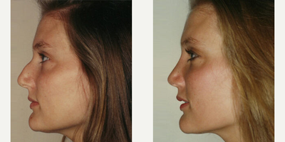 Case 4338 - Woman treated with Rhinoplasty