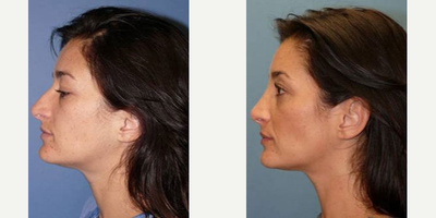 Case 4339 - Woman treated with Rhinoplasty