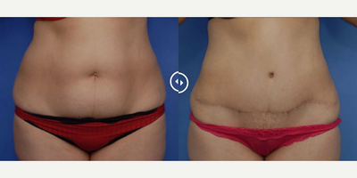 Case 434 - Woman treated with Tummy Tuck