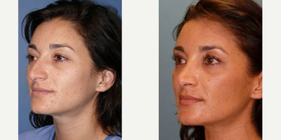 Case 4340 - Woman treated with Rhinoplasty