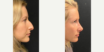 Case 4341 - Woman treated with Rhinoplasty