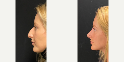 Case 4342 - Woman treated with Rhinoplasty