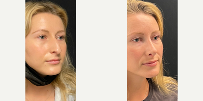 Case 4343 - Woman treated with Rhinoplasty