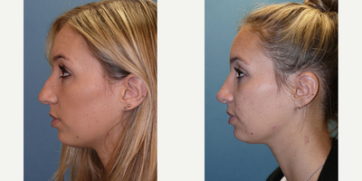 Case 4344 - Woman treated with Rhinoplasty