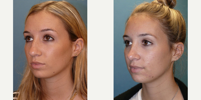 Case 4345 - Woman treated with Rhinoplasty