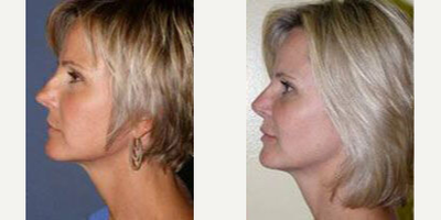 Case 4346 - Woman treated with Rhinoplasty