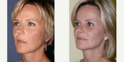 Case 4347 - Woman treated with Rhinoplasty