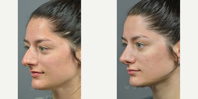 Case 4348 - Woman treated with Rhinoplasty