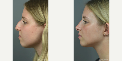 Case 4349 - Woman treated with Rhinoplasty
