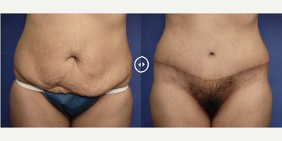 Case 435 - Woman treated with Tummy Tuck