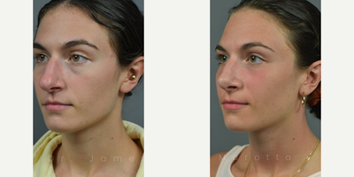 Case 4350 - Woman treated with Rhinoplasty