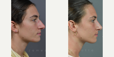 Case 4351 - Woman treated with Rhinoplasty