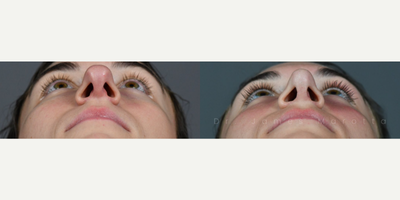 Case 4352 - Woman treated with Rhinoplasty