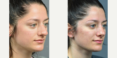 Case 4353 - Woman treated with Rhinoplasty
