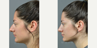 Case 4354 - Woman treated with Rhinoplasty