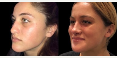 Case 4362 - Woman treated with Rhinoplasty