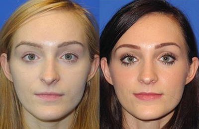 Case 4363 - Woman treated with Rhinoplasty