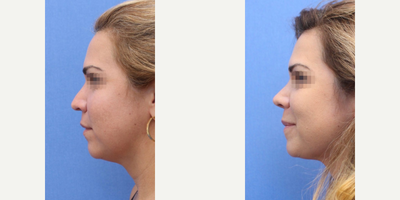 Case 4368 - Woman treated with Rhinoplasty