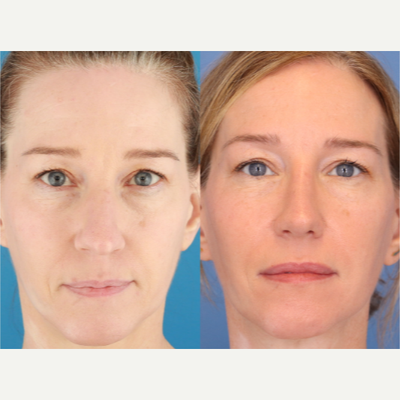 Case 4369 - 35-44 year old woman treated with Rhinoplasty