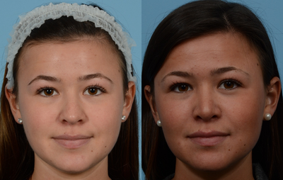 Case 4371 - Woman treated with Rhinoplasty