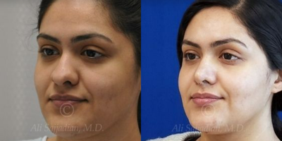 Case 4372 - Woman treated with Rhinoplasty