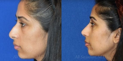 Case 4373 - Woman treated with Rhinoplasty