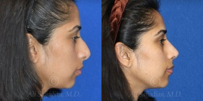 Case 4374 - Woman treated with Rhinoplasty