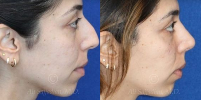 Case 4375 - Woman treated with Rhinoplasty