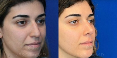 Case 4376 - Woman treated with Rhinoplasty