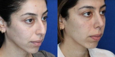 Case 4377 - Woman treated with Rhinoplasty
