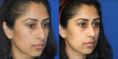 Case 4378 - Woman treated with Rhinoplasty