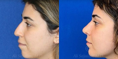 Case 4379 - Woman treated with Rhinoplasty