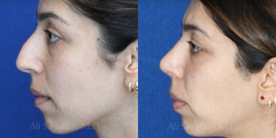 Case 4380 - Woman treated with Rhinoplasty