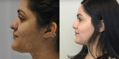 Case 4381 - Woman treated with Rhinoplasty