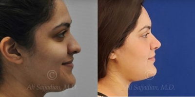 Case 4382 - Woman treated with Rhinoplasty