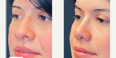 Case 4389 - Woman treated with Rhinoplasty