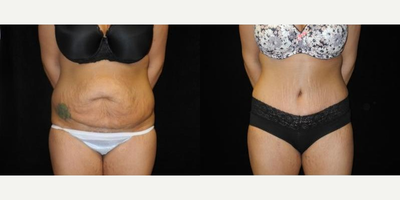 Case 439 - Woman treated with Tummy Tuck