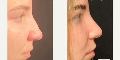 Case 4390 - Woman treated with Rhinoplasty