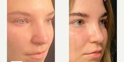 Case 4391 - Woman treated with Rhinoplasty