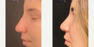 Case 4392 - Woman treated with Rhinoplasty