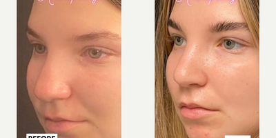 Case 4393 - Woman treated with Rhinoplasty