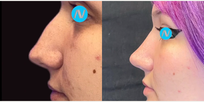 Case 4394 - Woman treated with Rhinoplasty