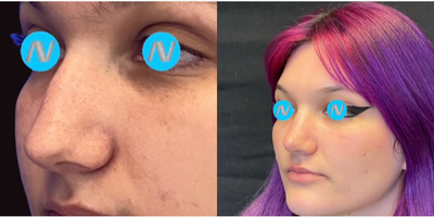 Case 4395 - Woman treated with Rhinoplasty