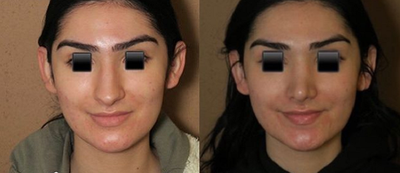 Case 4399 - Patient treated with Rhinoplasty